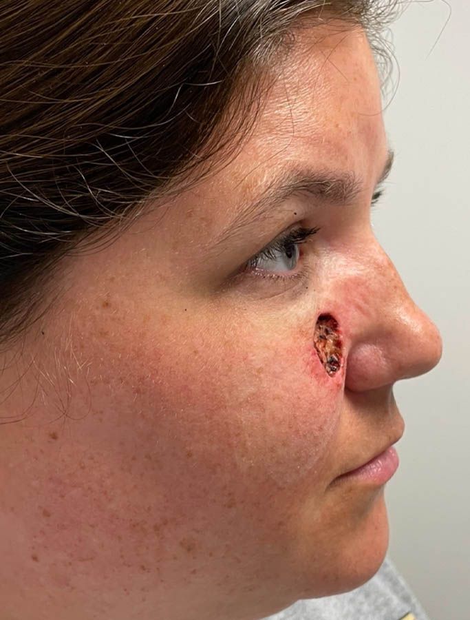 Before Image: Patient Case #17941 - right-side