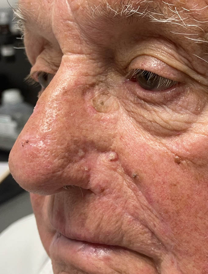 After Image: Patient Case #17955 - left-front-oblique