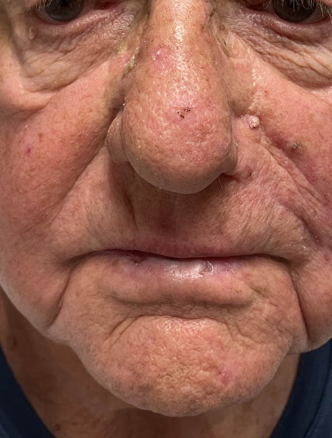 After Image: Patient Case #17955 - front