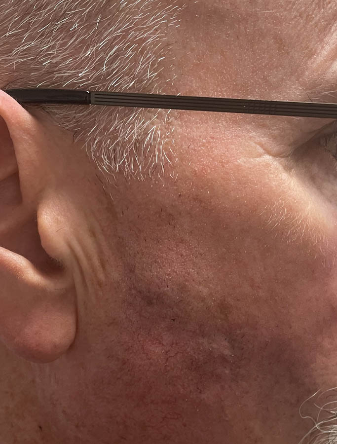 After Image: Patient Case #17960 - right-side