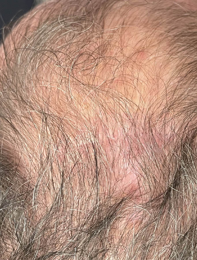 After Image: Patient Case #17963 - back