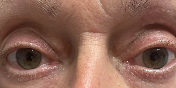 After Image: Patient Case #17972 - front