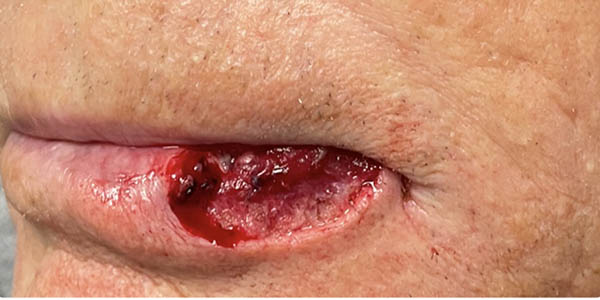 Before Image: Patient Case #17977 - left-side