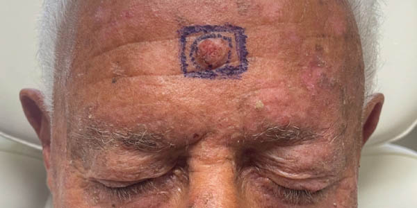 Before Image: Patient Case #17983 - front