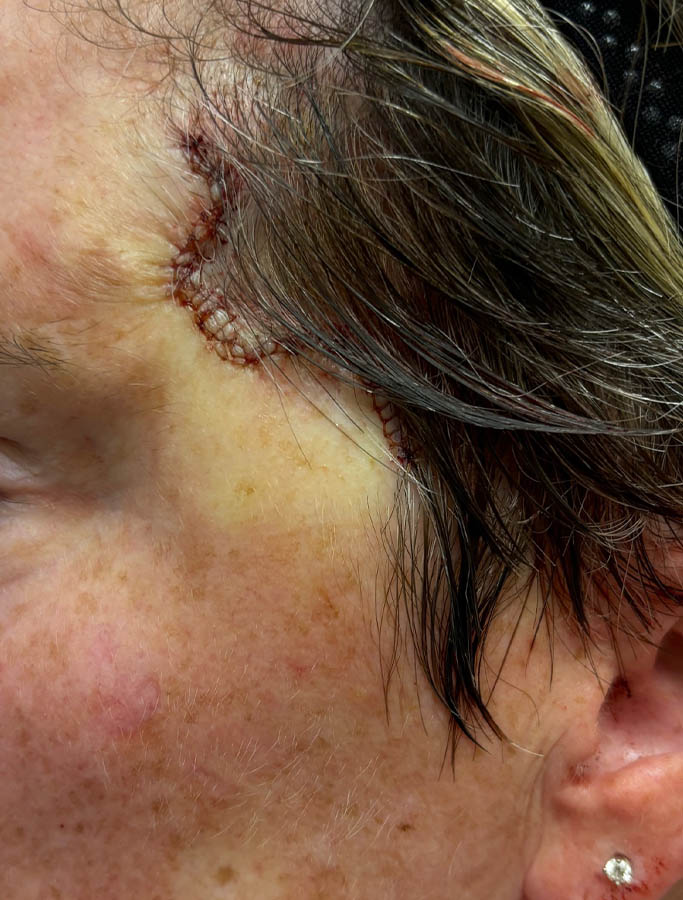 After Image: Patient Case #18005 - left-side