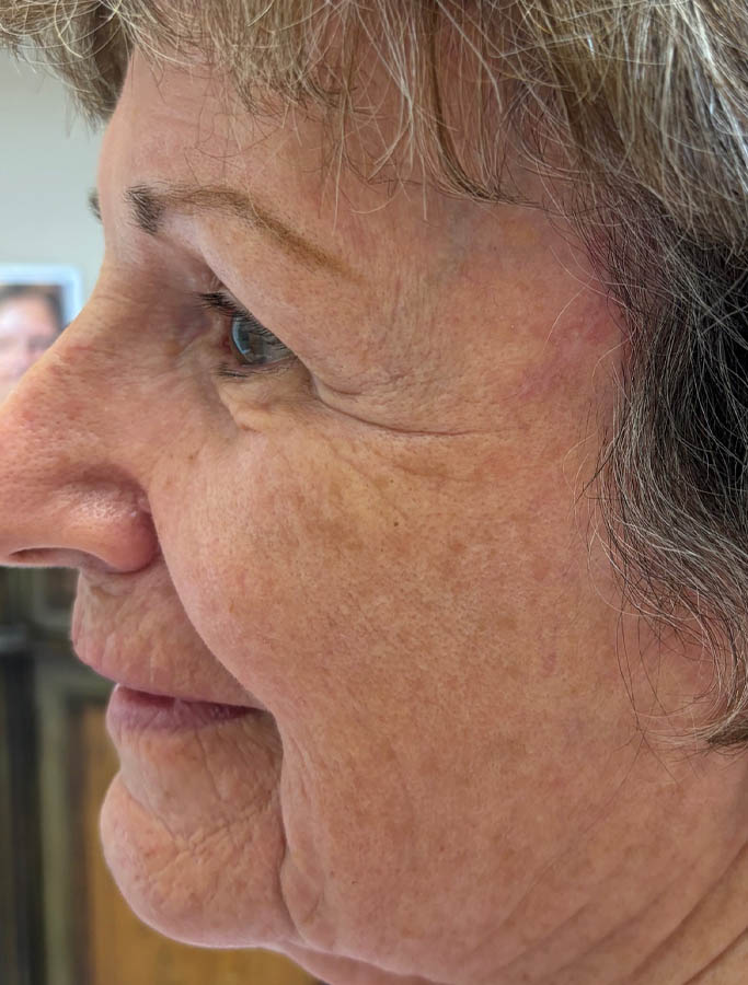 After Image: Patient Case #18019 - left-side