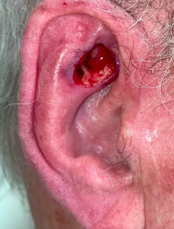 Before Image: Patient Case #18032 - right-side