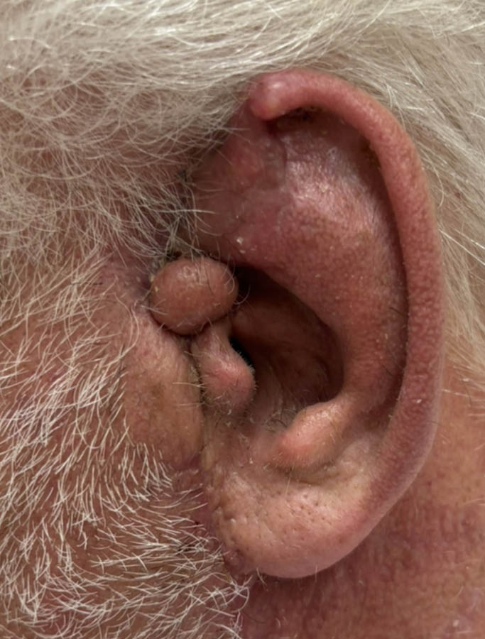 After Image: Patient Case #18035 - left-side