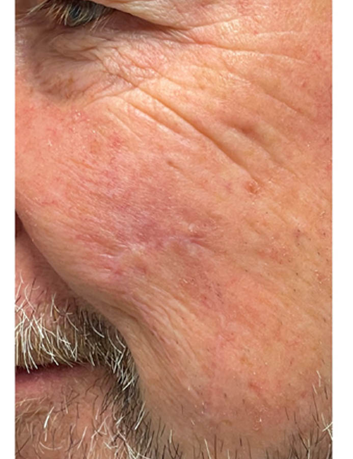 After Image: Patient Case #18054 - left-front-oblique