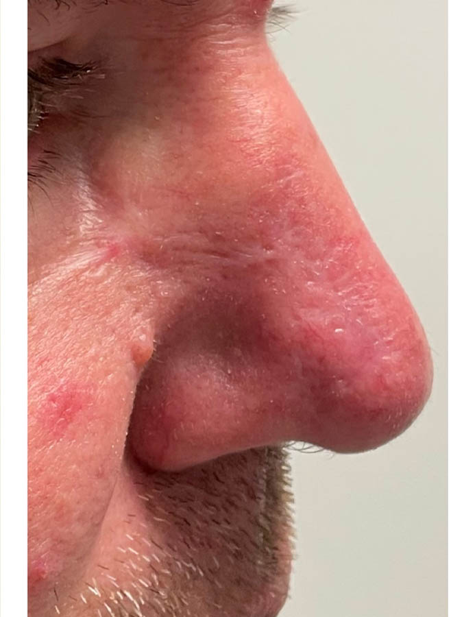 After Image: Patient Case #18057 - right-side