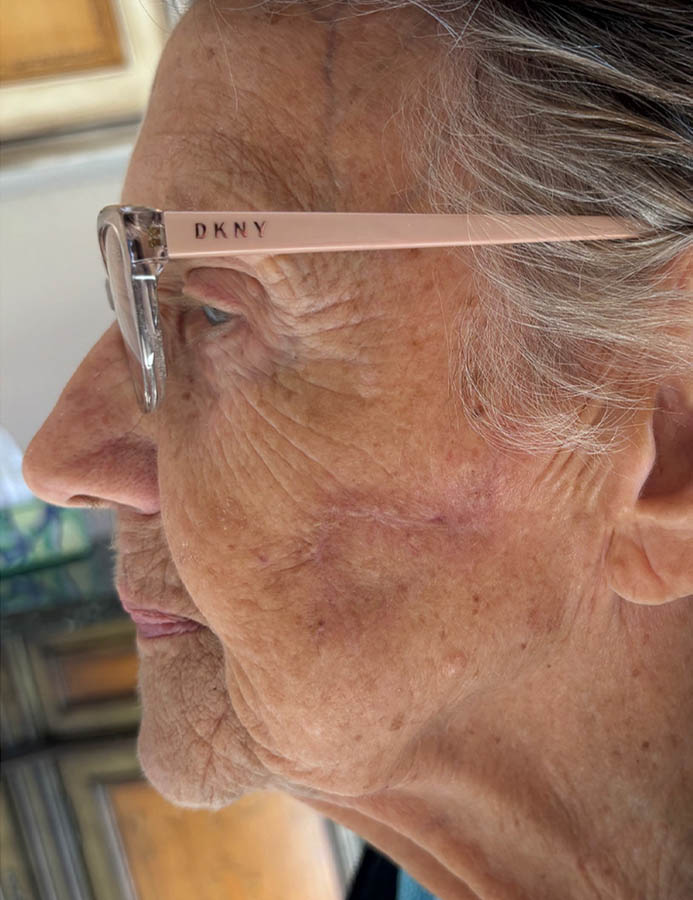 After Image: Patient Case #18063 - left-side