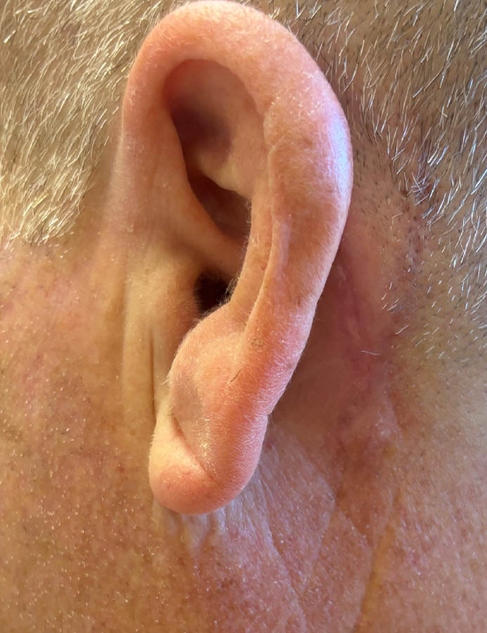 After Image: Patient Case #18066 - left-side