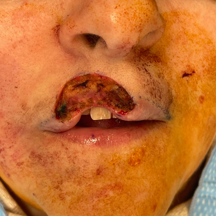 Before Image: Patient Case #18600 - front