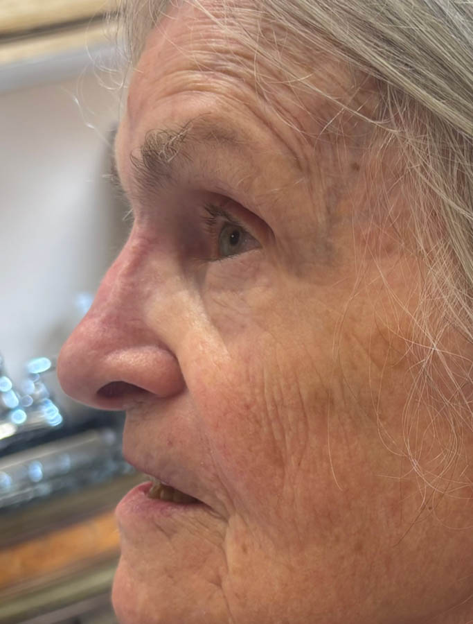 After Image: Patient Case #18882 - left-side