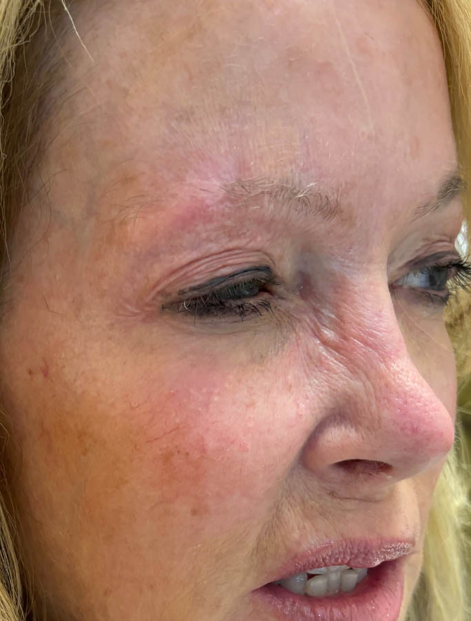 After Image: Patient Case #17926 - right-front-oblique