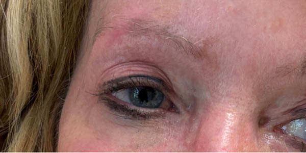 After Image: Patient Case #17926 - right-front-oblique