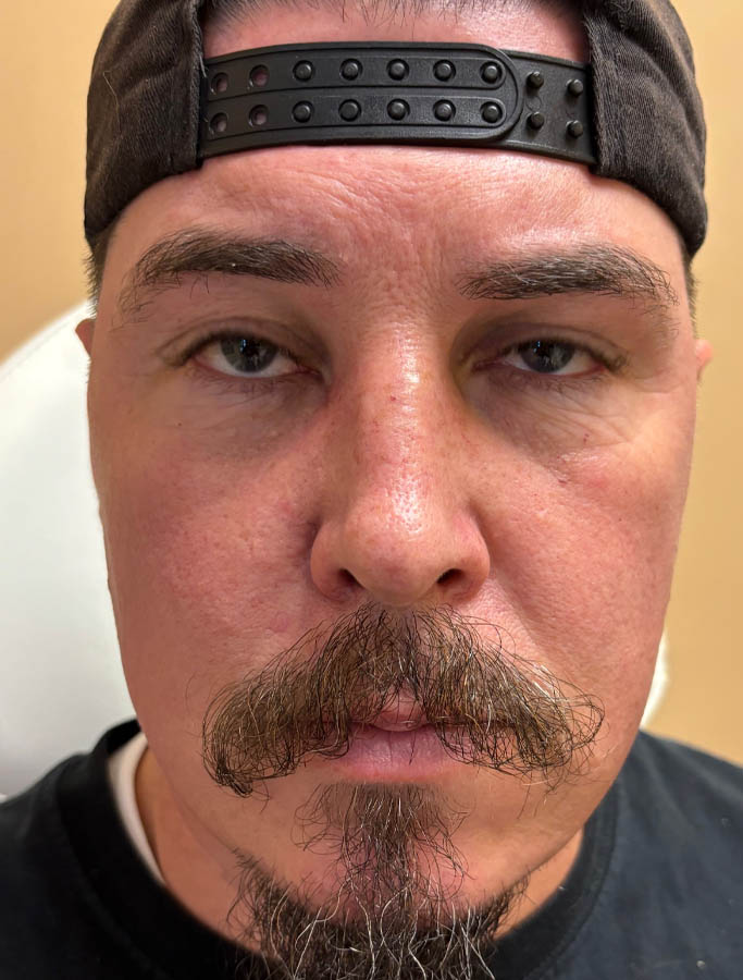 After Image: Patient Case #17934 - front